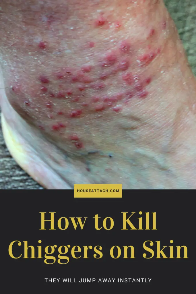 how to kill chiggers on skin